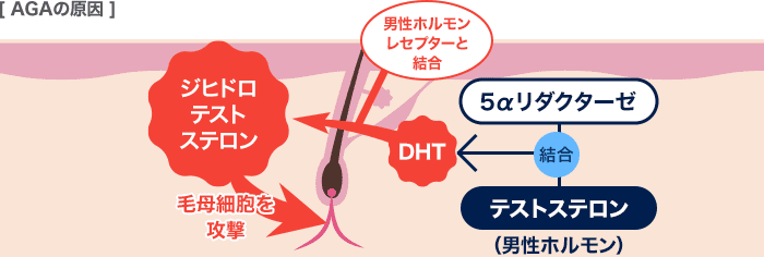 AGAの原因